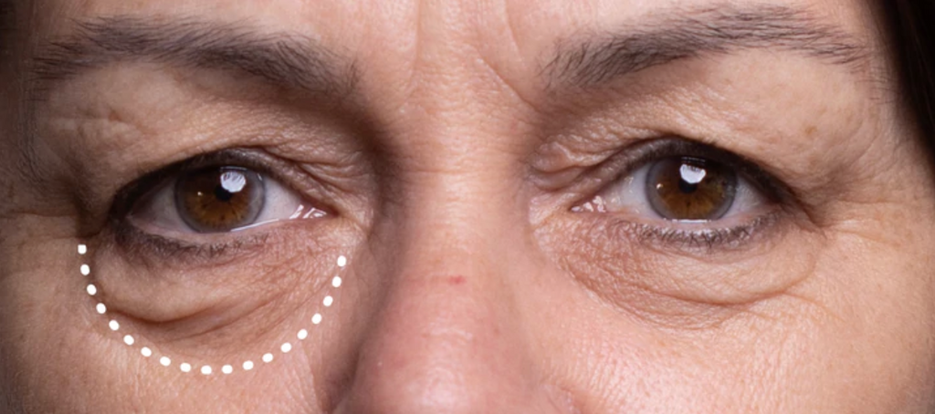 Are You Considering Eye Bag Removal Surgery?