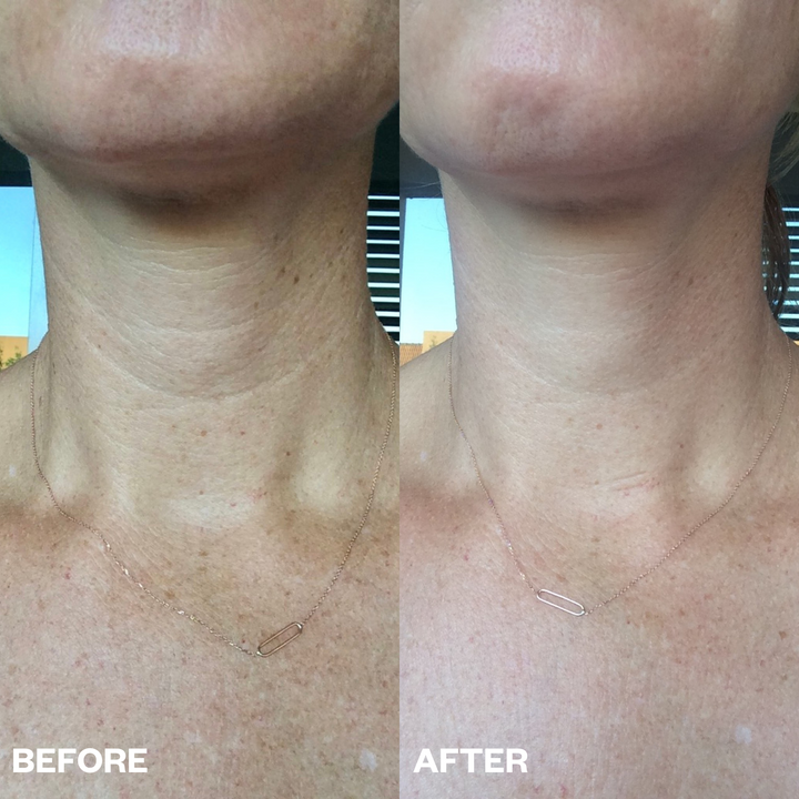 ws_neck_beforeafter